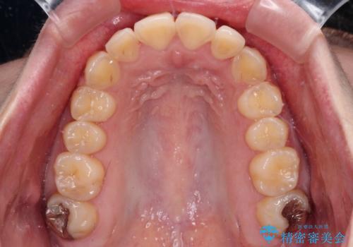 前歯のクロスバイトを改善 ワイヤー矯正を併用したインビザライン矯正の治療中