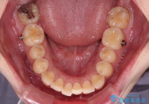 前歯のクロスバイトを改善 ワイヤー矯正を併用したインビザライン矯正の治療中