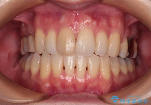 V字型に飛び出した前歯 ワイヤー装置での抜歯矯正の症例 治療後