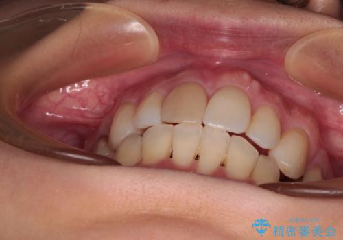 V字型に飛び出した前歯 ワイヤー装置での抜歯矯正の治療後