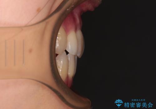 V字型に飛び出した前歯 ワイヤー装置での抜歯矯正の治療後