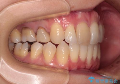 V字型に飛び出した前歯 ワイヤー装置での抜歯矯正の治療後