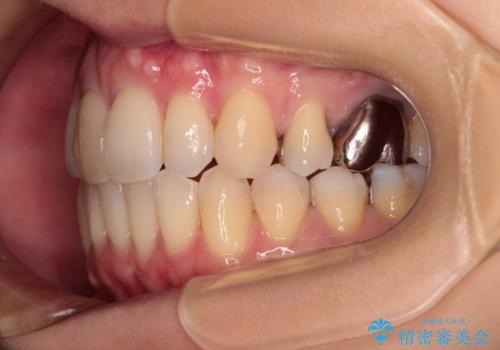 V字型に飛び出した前歯 ワイヤー装置での抜歯矯正の治療後