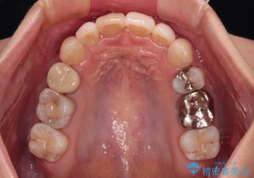 V字型に飛び出した前歯　ワイヤー装置での抜歯矯正の治療後