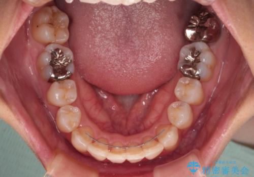 V字型に飛び出した前歯 ワイヤー装置での抜歯矯正の治療後