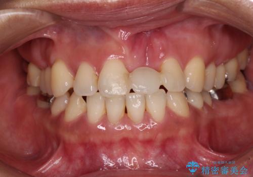 中途半端な矯正治療と前歯の欠損　再矯正とオールセラミッククラウンによる補綴治療の治療前