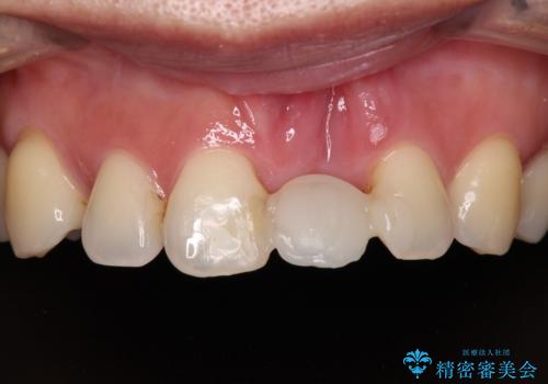 中途半端な矯正治療と前歯の欠損 再矯正とオールセラミッククラウンによる補綴治療の治療前