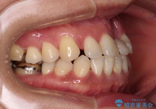 中途半端な矯正治療と前歯の欠損 再矯正とオールセラミッククラウンによる補綴治療の治療前