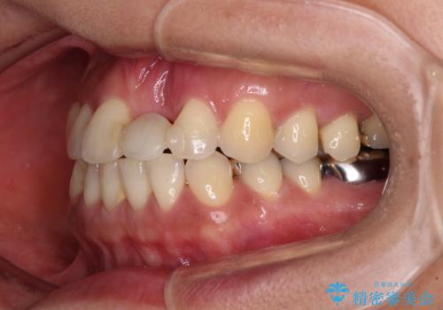 中途半端な矯正治療と前歯の欠損 再矯正とオールセラミッククラウンによる補綴治療の治療前