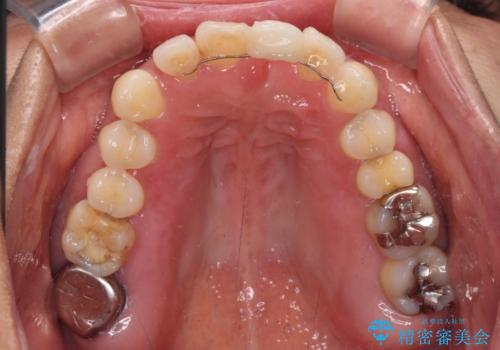 中途半端な矯正治療と前歯の欠損 再矯正とオールセラミッククラウンによる補綴治療の治療前