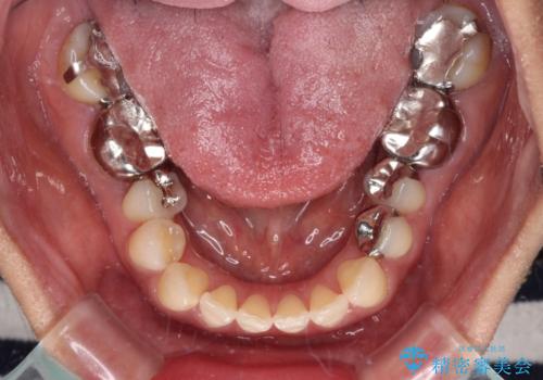 中途半端な矯正治療と前歯の欠損　再矯正とオールセラミッククラウンによる補綴治療の治療前