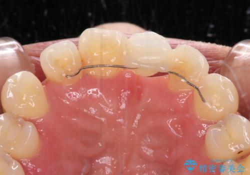 中途半端な矯正治療と前歯の欠損 再矯正とオールセラミッククラウンによる補綴治療の治療前