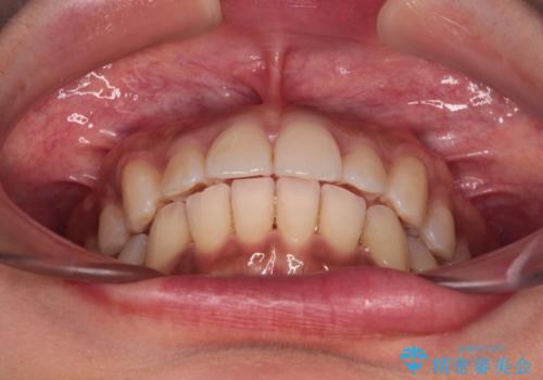 カリエール・ディスタライザーを併用したインビザライン矯正治療の治療後