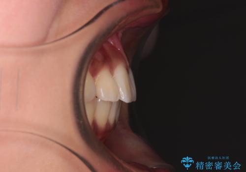 カリエール・ディスタライザーを併用したインビザライン矯正治療の治療後