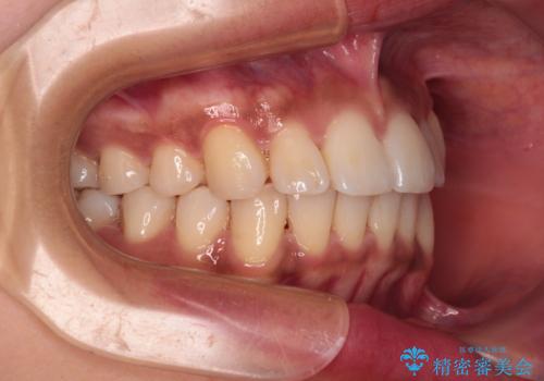 カリエール・ディスタライザーを併用したインビザライン矯正治療の治療後