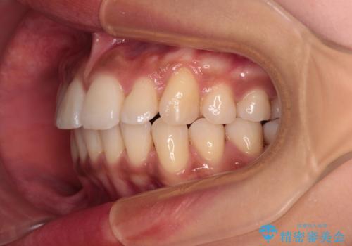 カリエール・ディスタライザーを併用したインビザライン矯正治療の治療後