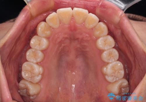 カリエール・ディスタライザーを併用したインビザライン矯正治療の治療後