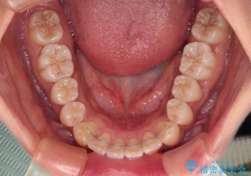 カリエール・ディスタライザーを併用したインビザライン矯正治療の治療後