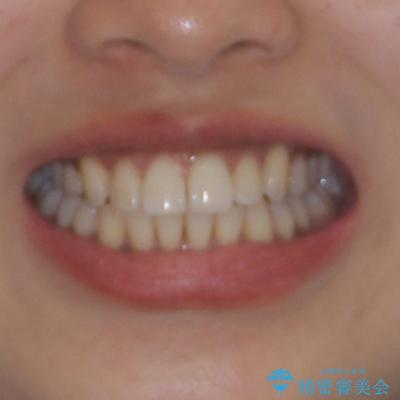 カリエール・ディスタライザーを併用したインビザライン矯正治療の治療後(顔貌)