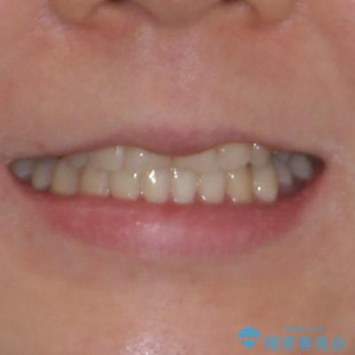 気になる歯列不正とむし歯を治療　インビザライン治療と虫歯治療の治療後（顔貌）