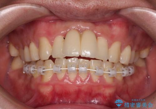 下顎前歯の部分矯正 目立たないワイヤー装置の治療中