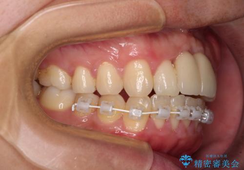 下顎前歯の部分矯正　目立たないワイヤー装置の治療中