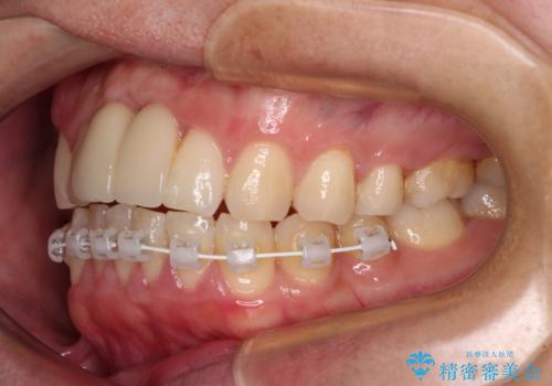 下顎前歯の部分矯正 目立たないワイヤー装置の治療中