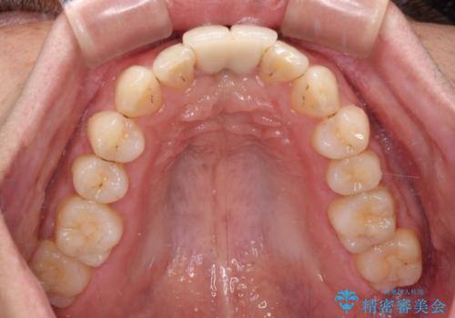 下顎前歯の部分矯正 目立たないワイヤー装置の治療中