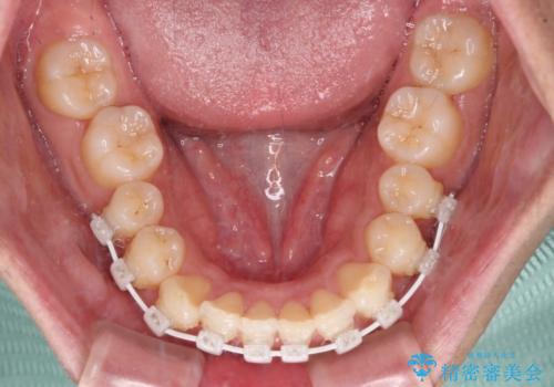 下顎前歯の部分矯正 目立たないワイヤー装置の治療中