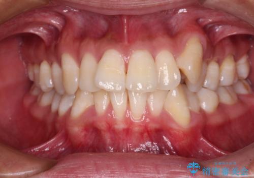 補助装置を併用してスムーズに インビザラインによる矯正治療の症例 治療前