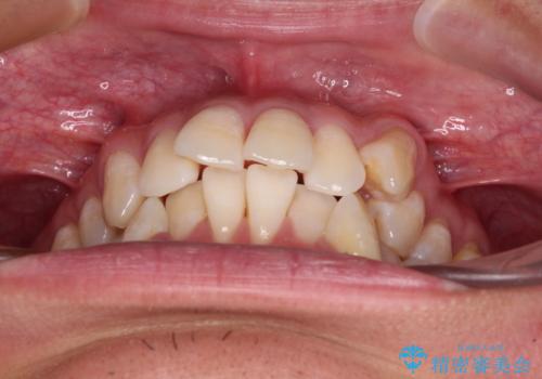 補助装置を併用してスムーズに インビザラインによる矯正治療の治療前