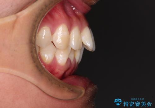 補助装置を併用してスムーズに インビザラインによる矯正治療の治療前