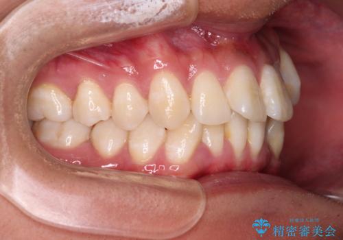 補助装置を併用してスムーズに インビザラインによる矯正治療の治療前