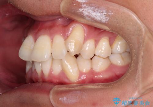 補助装置を併用してスムーズに インビザラインによる矯正治療の治療前