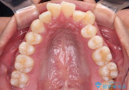 補助装置を併用してスムーズに インビザラインによる矯正治療の治療前