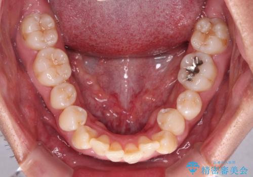 補助装置を併用してスムーズに インビザラインによる矯正治療の治療前
