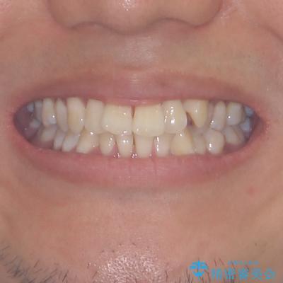 補助装置を併用してスムーズに インビザラインによる矯正治療の治療前(顔貌)