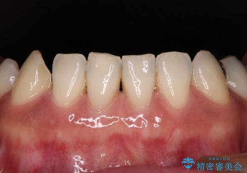 中途半端な矯正治療と前歯の欠損 再矯正とオールセラミッククラウンによる補綴治療の治療前