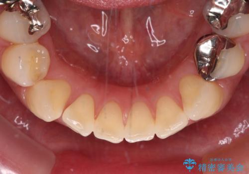 中途半端な矯正治療と前歯の欠損 再矯正とオールセラミッククラウンによる補綴治療の治療前