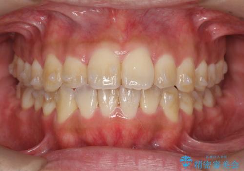 マウスピース矯正で前歯の見た目を治したいの治療中