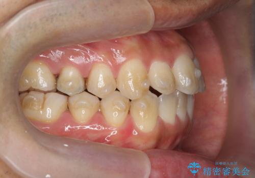 マウスピース矯正で前歯の見た目を治したいの治療中