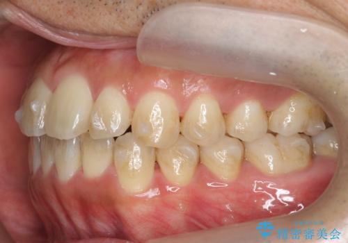 マウスピース矯正で前歯の見た目を治したいの治療中