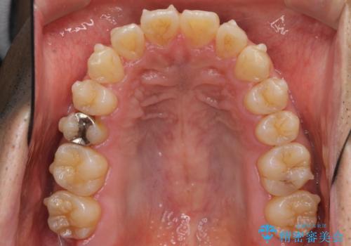 マウスピース矯正で前歯の見た目を治したいの治療中
