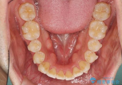 マウスピース矯正で前歯の見た目を治したいの治療中