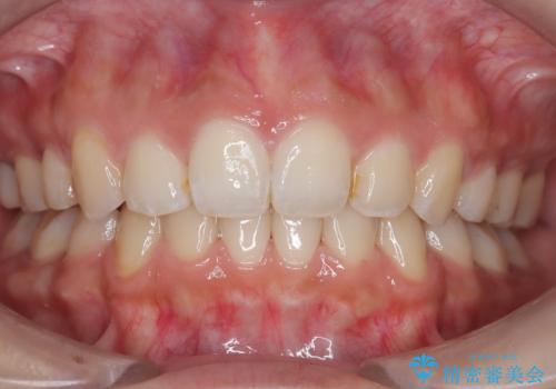 すっきり感アップ! ワイヤー矯正で口元を下げて魅力的な印象に!の症例 治療後