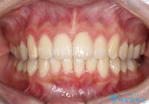 驚くほど短期間で前歯のガタツキを解消!　マウスピース矯正の効果の症例 治療後