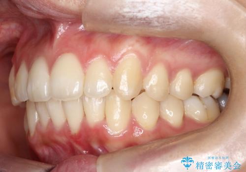 驚くほど短期間で前歯のガタツキを解消! マウスピース矯正の効果の治療後