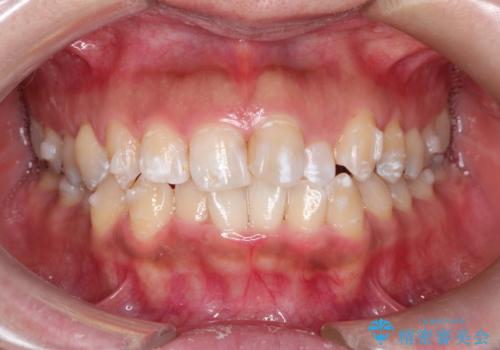 前歯のガタつきをマウスピース矯正で改善! 驚きの効果を体験しようの治療中