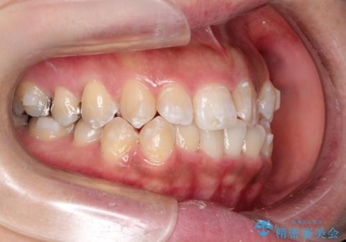 前歯のガタつきをマウスピース矯正で改善! 驚きの効果を体験しようの治療中