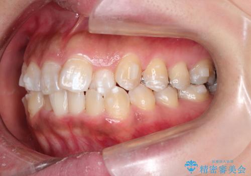 前歯のガタつきをマウスピース矯正で改善!　驚きの効果を体験しようの治療中